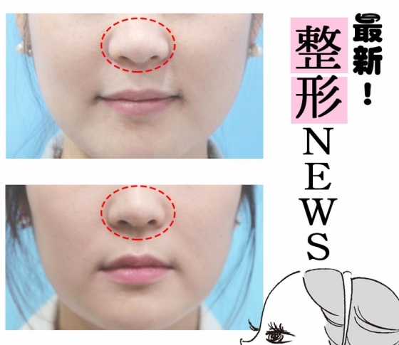 団子っ鼻・しゃくれアゴを卒業! 最新の整形技術はここまできている!【施術時間・費用をチェック!】