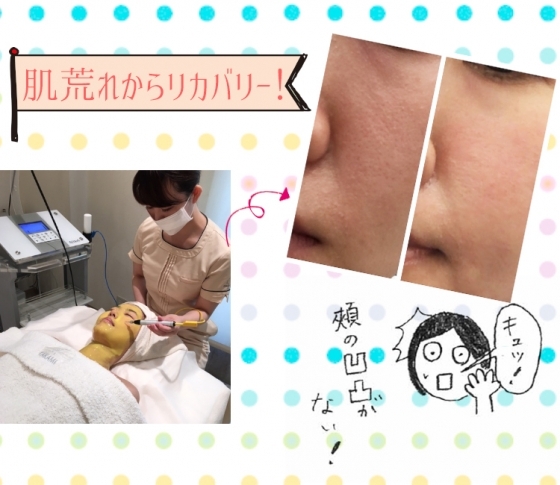 肌荒れからリカバリーするための意外なテク①