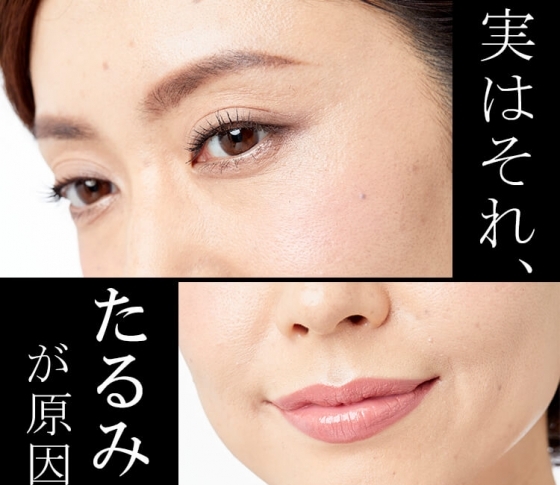 【たるみチェックリスト】ほうれい線は「シワ」ではない!「たるみ」でできる境界線なのです!!