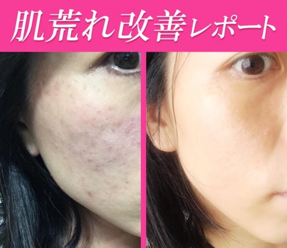 ヒドイ肌荒れがみるみる良くなったワケは? 食生活改善レポート