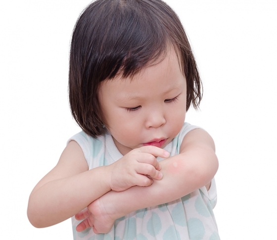 なかなか消えない虫刺され、色素沈着では!? その対処法とは